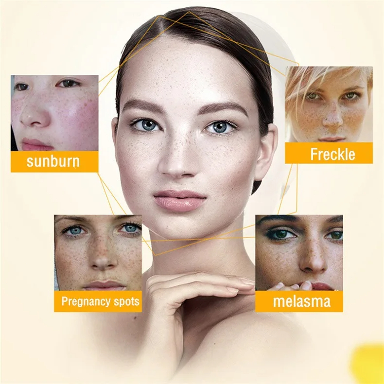 화이트닝 주근깨 크림 다크 스팟 제거 멜라스마 제거 안 - Skincare Glowing 리뷰 및 가격